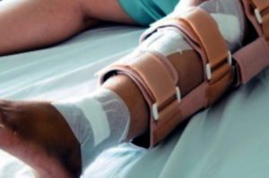 Broken fibula injury
