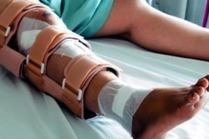 Person on a bed with their leg wrapped in bandages and supports following a broken leg at work accident. 