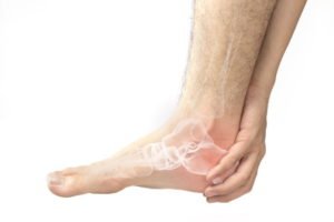 Fractured calcaneus injury