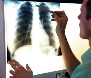 Fractured vertebrae injury