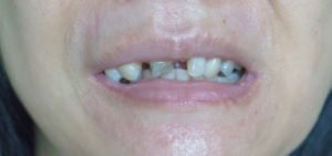 Broken teeth injury