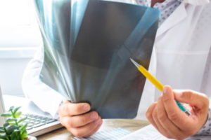 A person using a broken bone compensation calculator.