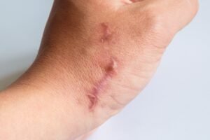Raised Scar On Hand. 