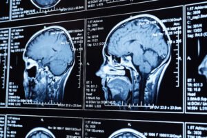Brain scan images.