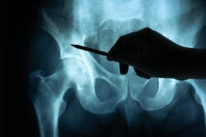 An image shows a fractured hip.