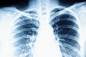 An up close x-ray of the chest 