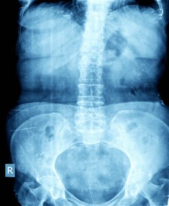An x-ray of the abdomen to provide an accurate diagnosis