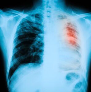 an x-ray of a patients chest