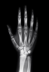 An x-ray image of a hand.