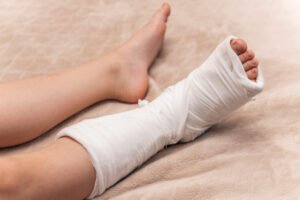 A woman wearing a foot and leg cast for a hairline fracture on her foot 