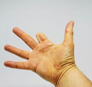 A hand with an amputated finger
