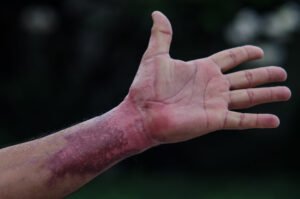 An outstretched hand with burn scarring across the palm and forearm