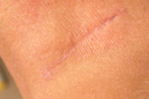 A permanent scar on someone's arm after a laceration accident