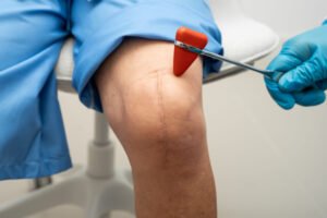 A physiotherapist is checking their patients leg and permanent scar
