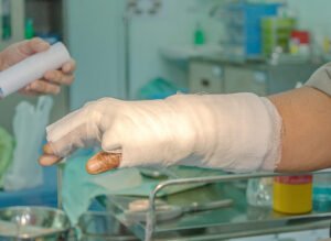 An arm wrapped in gauze due to suffering chemical burns.