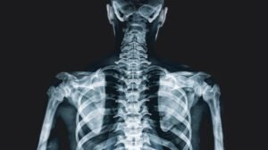 An X-ray showing the human thoracic skeleton and rib cage